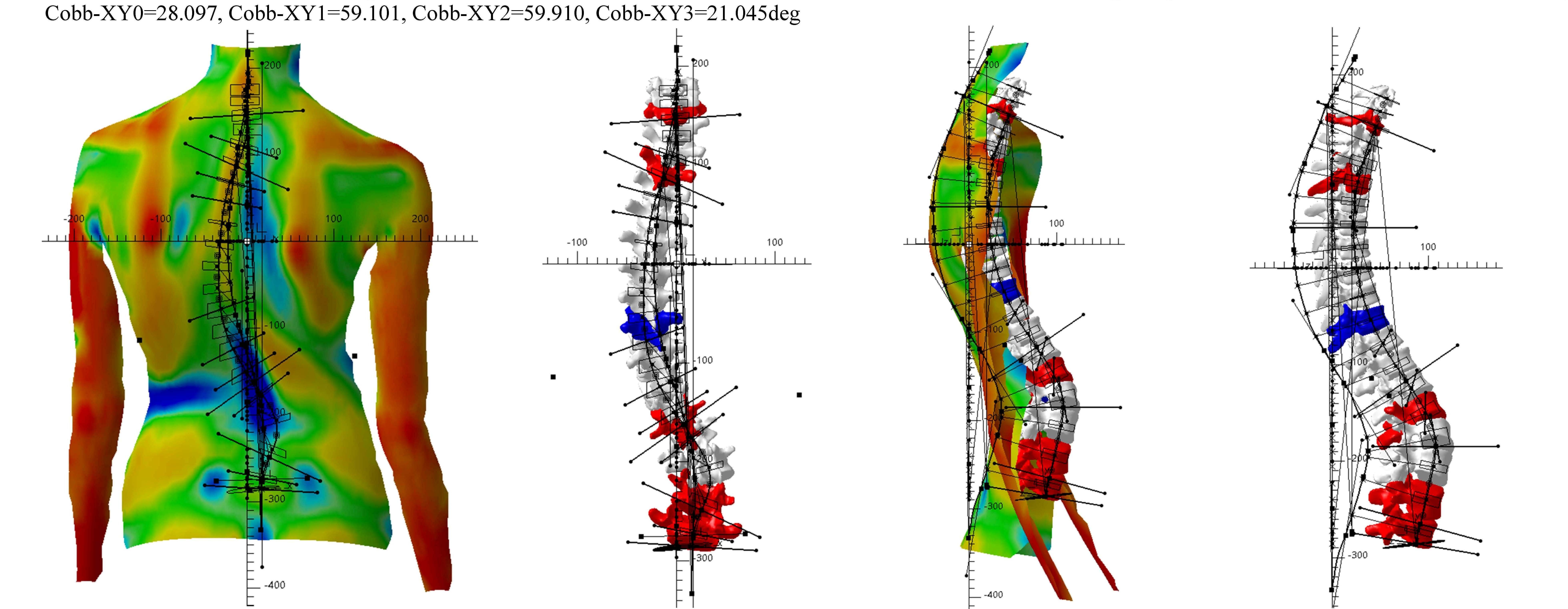 Vivid-Spine, une nouvelle approche non invasive du suivi de la scoliose 