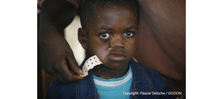 Mission Internationale au Burkina Faso pour sauver les enfants victimes du NOMA